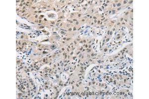 Immunohistochemistry of Human cervical cancer using CDC27 Polyclonal Antibody at dilution of 1:50 (CDC27 Antikörper)