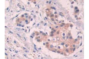 DAB staining on IHC-P; Samples: Human Breast cancer Tissue