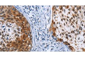 Immunohistochemistry of paraffin-embedded Human cervical cancer tissue using CRABP2 Polyclonal Antibody at dilution 1:40 (CRABP2 Antikörper)