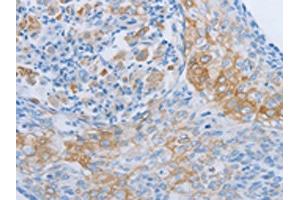 The image on the left is immunohistochemistry of paraffin-embedded Human cervical cancer tissue using ABIN7189704(ADRB3 Antibody) at dilution 1/60, on the right is treated with synthetic peptide. (ADRB3 Antikörper)