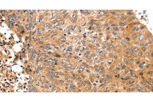 Immunohistochemistry of paraffin-embedded Human esophagus cancer tissue using ABCC9 Polyclonal Antibody at dilution 1:50 (ABCC9 Antikörper)