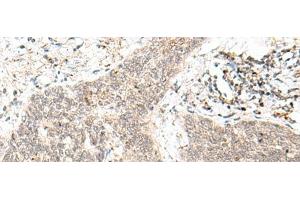 Immunohistochemistry of paraffin-embedded Human esophagus cancer tissue using FAM84B Polyclonal Antibody at dilution of 1:70(x200) (FAM84B Antikörper)