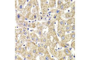Immunohistochemistry of paraffin-embedded Human liver injury using KIF3A antibody at dilution of 1:100 (x400 lens). (KIF3A Antikörper)