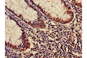 Immunohistochemistry of paraffin-embedded human colon cancer using ABIN7158683 at dilution of 1:100 (KARS Antikörper  (AA 101-400))