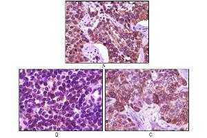 Immunohistochemical analysis of paraffin-embedded human lung carcinoma (A), lymph tissue (B) and skin carcinoma (C), showing membrane localization using BLK antibody with DAB staining. (BLK Antikörper)