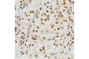 Immunohistochemistry of paraffin-embedded human kidney cancer using Lamin A/C antibody. (Lamin A/C Antikörper)