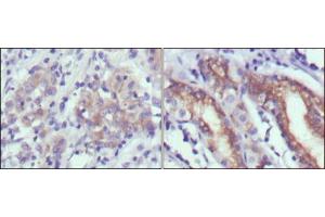 Immunohistochemical analysis of paraffin-embedded human gastric cancer (left) and normal gastric tissues (right) using CER1 mouse mAb with DAB staining. (CER1 Antikörper)