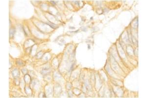 Immunohistochemical staining of Human Intestines Cancer (FGFR2 Antikörper  (C-Term))