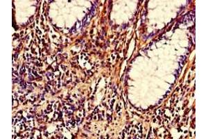Immunohistochemistry of paraffin-embedded human colon cancer using ABIN7161922 at dilution of 1:100 (NRIP2 Antikörper  (AA 1-281))
