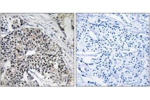 Immunohistochemistry analysis of paraffin-embedded human breast carcinoma tissue, using MRPL24 Antibody. (MRPL24 Antikörper  (AA 101-150))