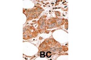 Formalin-fixed and paraffin-embedded human cancer tissue reacted with the primary antibody, which was peroxidase-conjugated to the secondary antibody, followed by AEC staining. (BCL2L14 Antikörper  (AA 194-229))