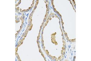 Immunohistochemistry of paraffin-embedded human prostate using CYP19A1 antibody (ABIN5971188) at dilution of 1/100 (40x lens). (Aromatase Antikörper)
