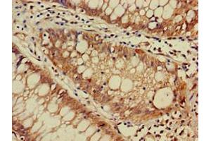 Immunohistochemistry of paraffin-embedded human colon cancer using ABIN7150558 at dilution of 1:100 (DNAJC4 Antikörper  (AA 1-155))