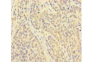 Immunohistochemistry of paraffin-embedded human ovarian cancer using ABIN7162611 at dilution of 1:100 (PAPPA Antikörper  (AA 95-302))