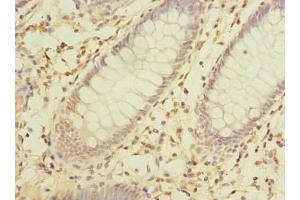 Immunohistochemistry of paraffin-embedded human colon cancer using ABIN7142357 at dilution of 1:100 (MRPL16 Antikörper  (AA 37-251))