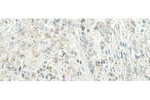 Immunohistochemistry of paraffin-embedded Human breast cancer tissue using UQCC2 Polyclonal Antibody at dilution of 1:60(x200) (MNF1 Antikörper)