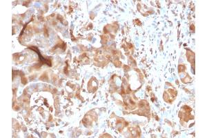 Formalin-fixed, paraffin-embedded human Hepatic Carcinoma stained with FABP5 Mouse Monoclonal Antibody (CPTC-FABP5-3).