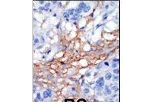 Formalin-fixed and paraffin-embedded human cancer tissue reacted with the primary antibody, which was peroxidase-conjugated to the secondary antibody, followed by AEC staining. (PIP5K1C Antikörper  (C-Term))