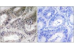 Immunohistochemistry analysis of paraffin-embedded human colon carcinoma tissue, using COX19 Antibody. (COX19 Antikörper  (AA 10-59))