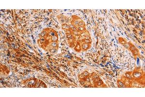 Immunohistochemistry of paraffin-embedded Human cervical cancer using SLC25A4 Polyclonal Antibody at dilution of 1:40