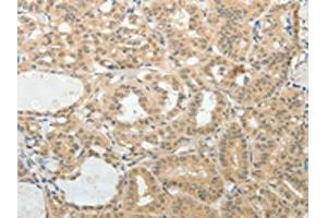 The image on the left is immunohistochemistry of paraffin-embedded Human thyroid cancer tissue using ABIN7189710(AFF2 Antibody) at dilution 1/25, on the right is treated with synthetic peptide.