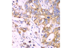 Immunohistochemistry of paraffin-embedded human liver cancer using RPS3A Antibody. (RPS3A Antikörper)