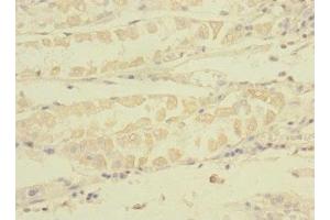 Immunohistochemistry of paraffin-embedded human gastric cancer using  at dilution of 1:100 (TNRC6A Antikörper  (AA 1-161))
