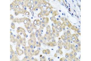 Immunohistochemistry of paraffin-embedded Human liver damage using RAB24 Polyclonal Antibody at dilution of 1:100 (40x lens). (RAB24 Antikörper)