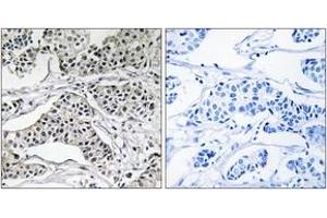 Immunohistochemistry analysis of paraffin-embedded human breast carcinoma tissue, using PLD3 Antibody. (PLD3 Antikörper  (AA 326-375))