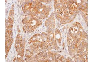 IHC-P Image Immunohistochemical analysis of paraffin-embedded N87 xenograft, using DUSP3, antibody at 1:500 dilution. (Dual Specificity Phosphatase 3 (DUSP3) Antikörper)