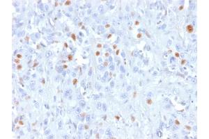 Formalin-fixed, paraffin-embedded human Urothelial carcinoma stained with p21 Mouse Recombinant Monoclonal Antibody (rCIP1/823).
