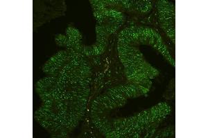 IF analysis of PHF21A using anti-PHF21A antibody (ABIN6719353) PHF21A was detected in paraffin-embedded section of human intestinal cancer tissues.