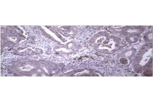 Immunohistochemical staining of paraffin embedded colon carcinoma using MMP9 antibody . (MMP 9 Antikörper  (C-Term))