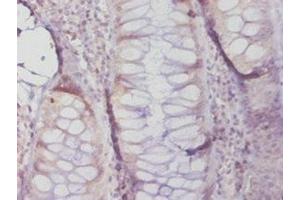 Immunohistochemistry of paraffin-embedded human colon cancer using ABIN7159622 at dilution of 1:20 (MGMT Antikörper  (AA 4-207))