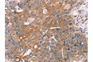 The image on the left is immunohistochemistry of paraffin-embedded Human breast cancer tissue using ABIN7130502(OPTN Antibody) at dilution 1/25, on the right is treated with fusion protein. (OPTN Antikörper)