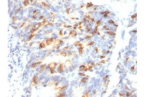 Formalin-fixed, paraffin-embedded human Colon Carcinoma stained with MUC2 Mouse Monoclonal Antibody (MLP/842). (MUC2 Antikörper)
