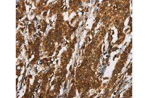 Immunohistochemical analysis of paraffin-embedded Human gastric cancer tissue using at dilution 1/25. (CTAG1A Antikörper  (Internal Region))
