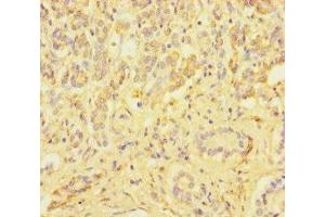 Immunohistochemistry of paraffin-embedded human pancreatic cancer using ABIN7176008 at dilution of 1:100 (ZSCAN29 Antikörper  (AA 1-300))