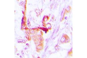 Immunohistochemical analysis of EEF2 staining in human lung cancer formalin fixed paraffin embedded tissue section. (EEF2 Antikörper  (N-Term))