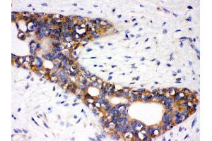Anti- AGTR1 Picoband antibody, IHC(P) IHC(P): Human Mammary Cancer Tissue (Angiotensin II Type-1 Receptor Antikörper  (N-Term))