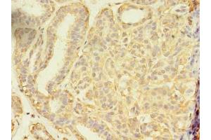 Immunohistochemistry of paraffin-embedded human breast cancer using ABIN7166213 at dilution of 1:100