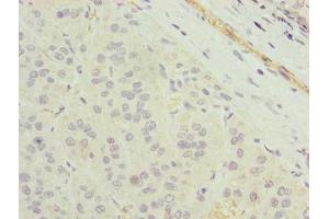 Immunohistochemistry of paraffin-embedded human liver cancer using ABIN7173103 at dilution of 1:100 (TMEM177 Antikörper  (AA 219-311))