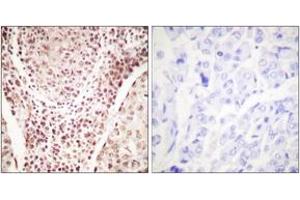 Immunohistochemistry analysis of paraffin-embedded human breast carcinoma, using Chk2 (Phospho-Thr387) Antibody. (CHEK2 Antikörper  (pThr387))