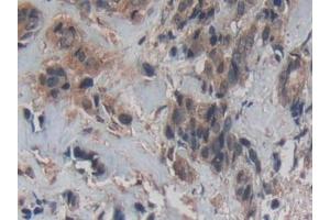 Detection of Cys-C in Human Breast cancer Tissue using Polyclonal Antibody to Cystatin C (Cys-C) (Cystathionine-gamma-Synthase Precursor (CYS) (AA 27-146) Antikörper)