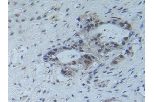 Detection of Raftlin in Human Pancreas Cancer Tissue using Polyclonal Antibody to Raft Linking Protein (Raftlin) (RFTN1 Antikörper  (AA 288-520))