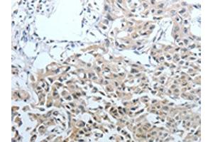 The image on the left is immunohistochemistry of paraffin-embedded Human lung cancer tissue using ABIN7128892(CEACAM1 Antibody) at dilution 1/25, on the right is treated with fusion protein. (CEACAM1 Antikörper)