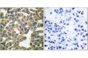Immunohistochemistry (IHC) image for anti-Matrix Metallopeptidase 13 (Collagenase 3) (MMP13) (AA 10-59) antibody (ABIN2889227) (MMP13 Antikörper  (AA 10-59))