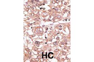 Formalin-fixed and paraffin-embedded human hepatocellular carcinoma tissue reacted with TLR7 polyclonal antibody  , which was peroxidase-conjugated to the secondary antibody, followed by AEC staining. (TLR7 Antikörper  (N-Term))