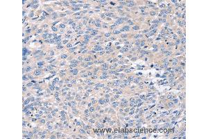 Immunohistochemistry of Human prostate cancer using ROR1 Polyclonal Antibody at dilution of 1:35 (ROR1 Antikörper)