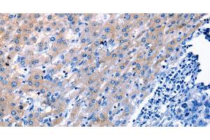 Immunohistochemistry of paraffin-embedded Human liver cancer tissue using LAMA3 Polyclonal Antibody at dilution 1:30 (LAMA3 Antikörper)